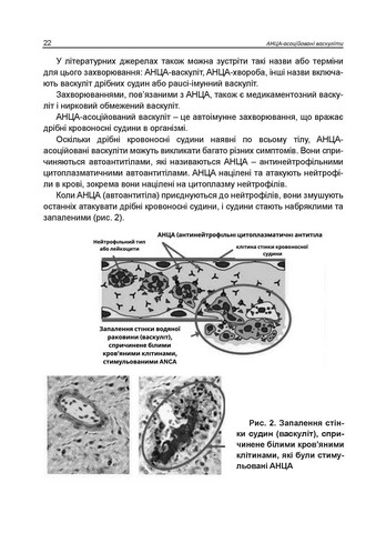 АНЦА-асоційовані васкуліти Авт: Катеренчук І.П. Гуцаленко O.O. Ярмола T.І. Вид-во: Медкнига - фото 7